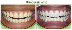 Blanqueamiento 02